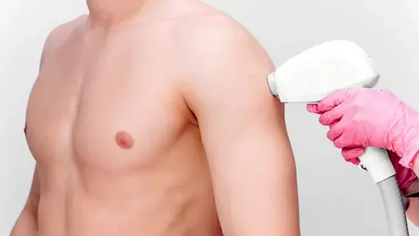 лазерная эпиляция плеч для мужчин