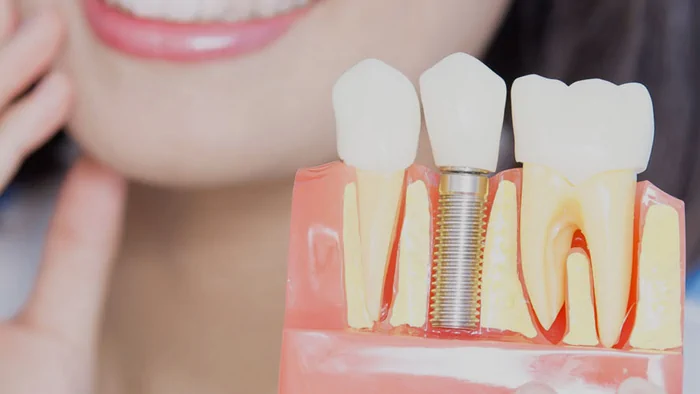 Імплантація зубів допомагає відновити втрачені зуби та повернути красу посмішці