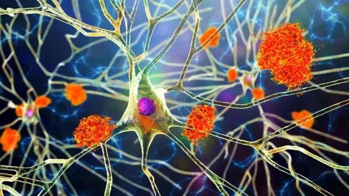 Повышает риск развития болезни Альцгеймера: стресс оказался катализатором заболевания