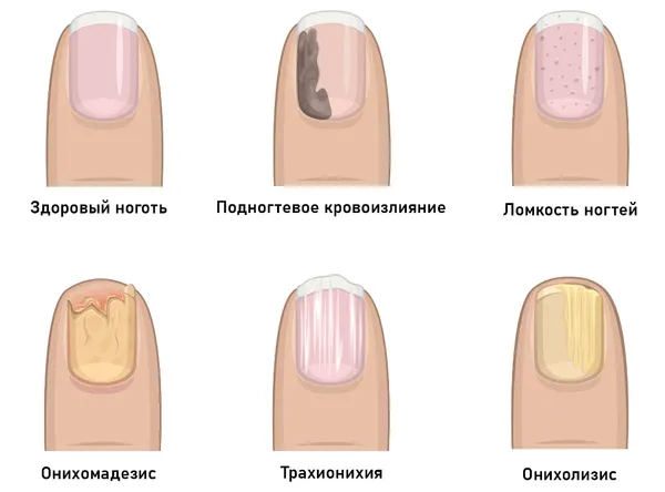 заболевания ногтей