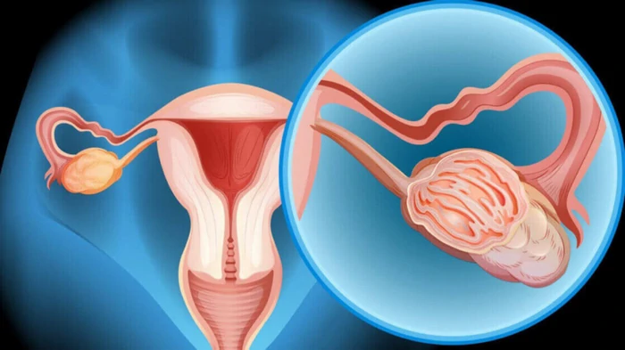 метастази раку яєчників
