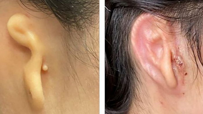Врачи имплантировали человеку ухо, напечатанное на 3D-принтере